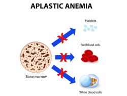 Heboh! Obat Sakit Kepala Diduga Picu Penyakit Anemia Aplastik, Ini Faktanya